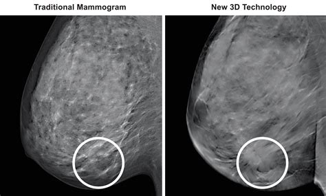 3D Mammography .